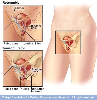 Figura representativa das cirurgias de sling